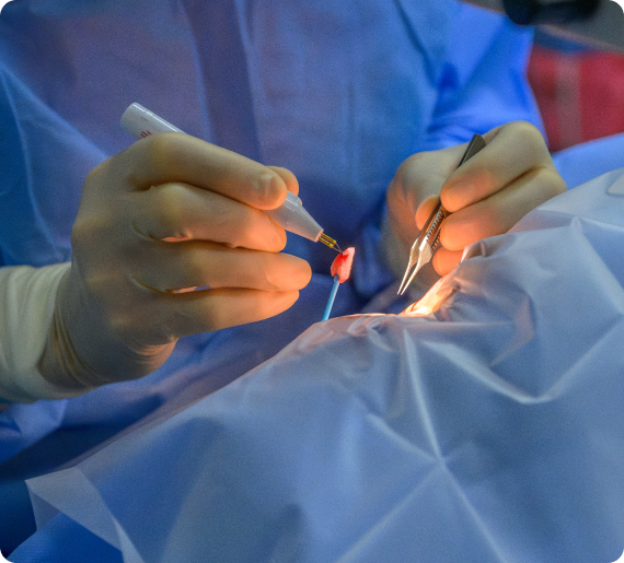 corneal-transplant